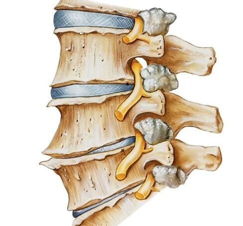 Pinching the nerve in the spine