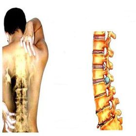 Osteochondrosis stages