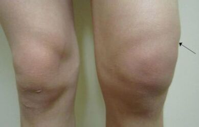 Clinical manifestations of knee articulation arthrosis