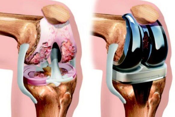 Before and after the knee joint endoprothetic with arthrosis
