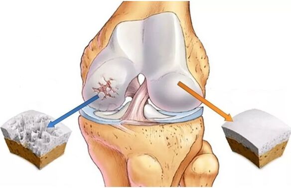 Healthy cartilage and cartilage affected by arthrosis