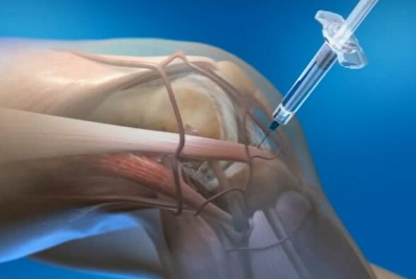 Intra -articular injections for knee joint arthrosis