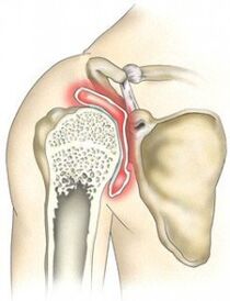 destruction of the shoulder joint due to arthrosis