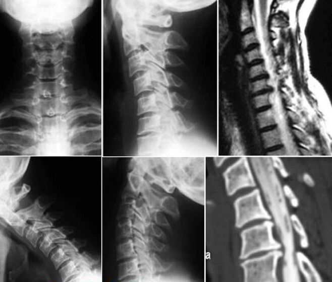 Cervical spine radiography for the diagnosis of osteochondrosis